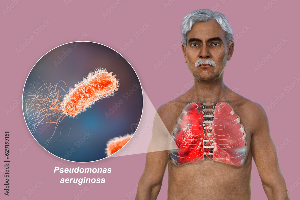 Sticker A 3D illustration showcasing the upper half part of a man with transparent skin, revealing the lungs affected by pneumonia