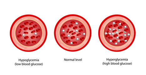 Blood Glucose Levels. Normal level, hypoglycemia (low blood sugar), hyperglycemia (high blood sugar), sugar test. vector diagram	
