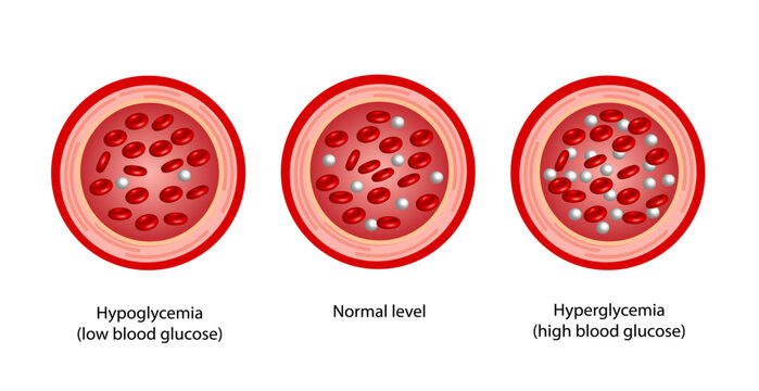 Blood Glucose Levels. Normal level, hypoglycemia (low blood sugar), hyperglycemia (high blood sugar), sugar test. vector diagram	
