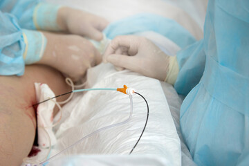 Close up catheter is inserted into patient's lower limb on operating table in treatment varicose...