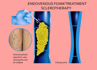 Endovenous laser treatment for varicose veins - foam sclerotherap concept.