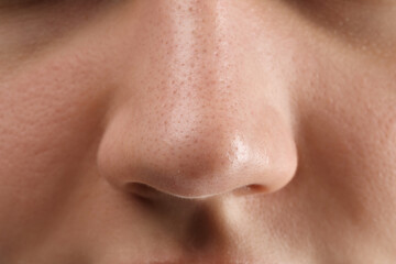 Young woman with acne problem, closeup view