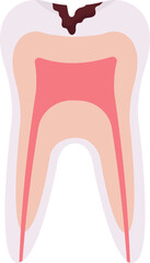Deep Caries Tooth Problem