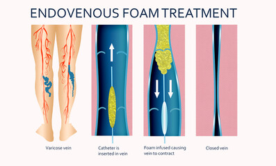 Varicose Veins. Endovenous foam Treatment. Structure of vein