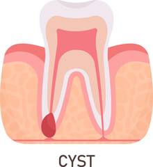 Cyst Tooth Problem