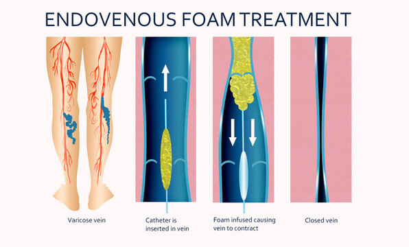 Varicose Veins. Endovenous foam Treatment. Structure of vein