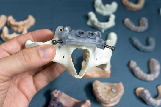 Retainers for implantation on the upper jaw. Dental implants.