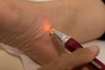 Holistic medicine and acupuncture concept: detail of a foot treatment with pulsed light. - 629514326