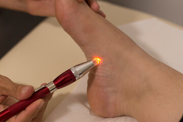 Holistic medicine and acupuncture concept: detail of a foot treatment with pulsed light. - obrazy, fototapety, plakaty