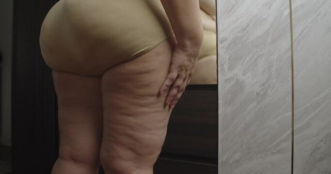 Asian oversize woman care about cellulite on her legs. Excess fat, Unhealthy lifestyle, Diet concept.