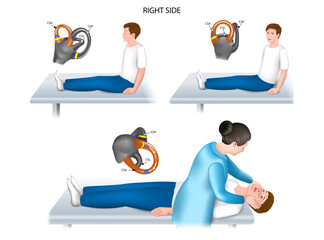 Dix-Hallpike test right