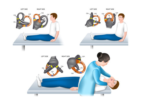 General Dix-Hallpike test