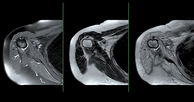 Magnetic Resonance Imaging or MRI of Shoulder Joint axial T1FS , T2 and Gredient for diagnostic shoulder pain.