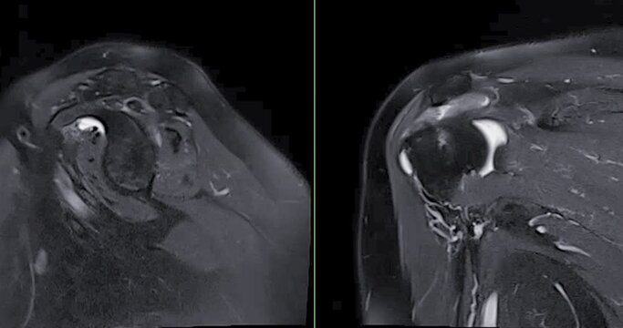 Magnetic Resonance Imaging or MRI of Shoulder Joint sagittal and  Coronal T2FS and PDW  for diagnostic shoulder pain.