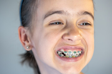 Teenage girl with braces on her teeth, close-up of a smile.