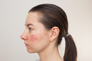 close-up profile of a young dark-haired Caucasian woman suffering from the skin disease rosacea on...