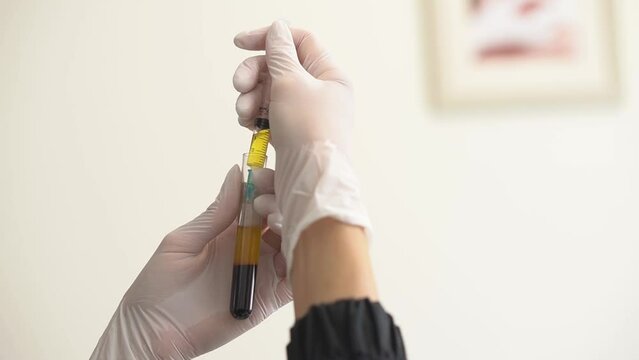 Close up female doctor hands in medical gloves draws blood plasma from a test tube into a syringe. The concept of laboratory blood tests and cosmetic injections of PRP therapy for the beauty of skin
