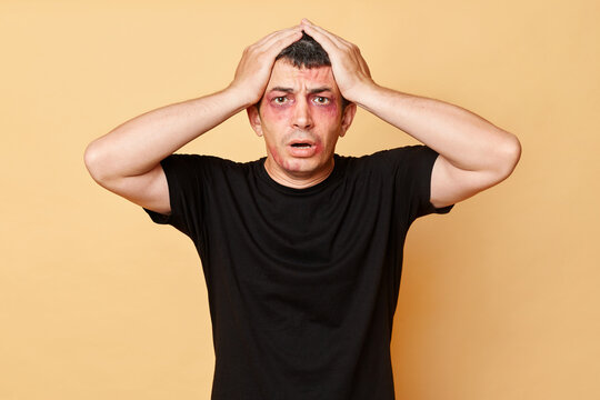 Shocked despair sufferer man in black T-shirt with bruises and abrasions on his face isolated over beige background standing with hands on head has problems with bandits.