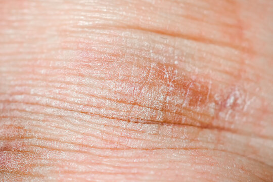 Dry skin or ichthyosis texture detail. Extreme close up macro shot dehydration skin. Dermatology and skincare concept