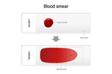 Blood smear for hematology microscopic. Method of placing drop of blood sample onto glass slide.
