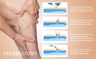 Ambulatory Phlebectomy Treatment for varicose vein.