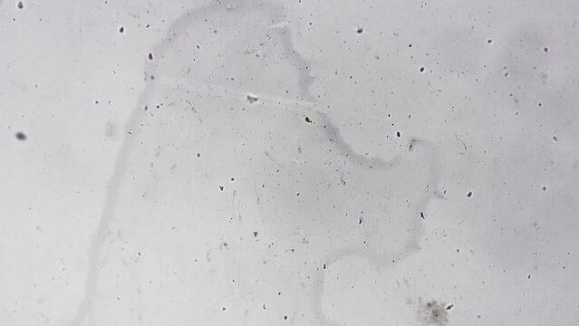 Macro footage of sperm smear sample magnified under microscope 200x and studied in the lab on bright field background. Determining various factors such as quality and fertility. Planning pregnancy