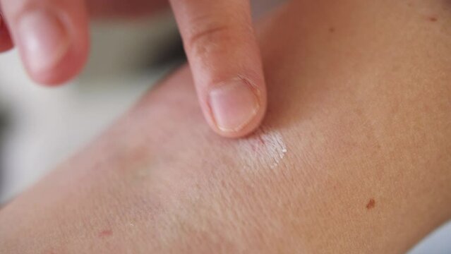 Person swab a skin disease with an ointment. Shingles, Disease, Herpes zoster, varicella-z, lichenoid dermatitis