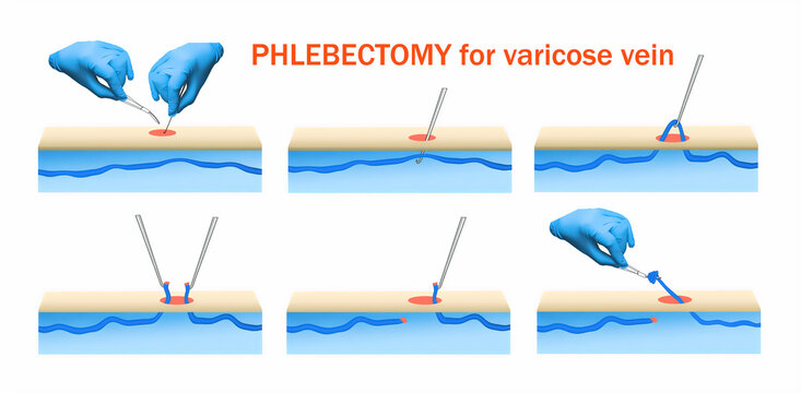 Ambulatory Phlebectomy Treatment for varicose vein.