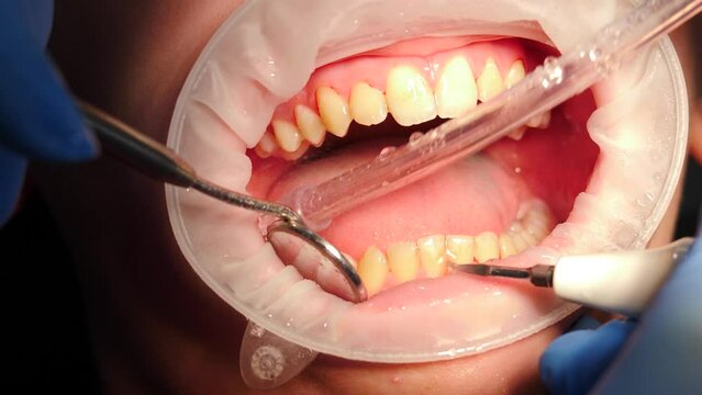 Dentistry and oral hygiene. Dental whitening work. dental care and stomatology. Teeth cleaning removing plaque stones. Professional cleaning dental plaque and polishing childs teeth, Pediatric