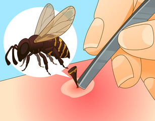 Bee sting. Extract the sting. Injury after a bee sting. Redness on the skin. Closeup illustration. Healthcare illustration, vector illustration. 
