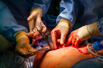 Surgical operation, closeup on operating field and hands of surgeons