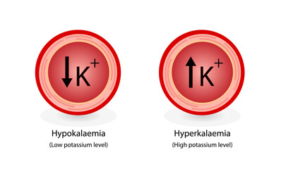 Hyperkalaemia, high plasma potassium level and Hypokalaemia, low plasma potassium level. Potassium K excess and deficit electrolyte disorders, blood test tube, Scientific design. Vector illustration.