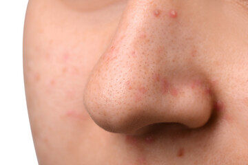 Young woman with acne problem, closeup view of nose