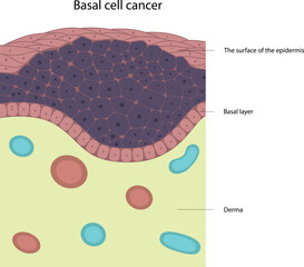 Basal cell cancer. Skin disease. Tumor cells.