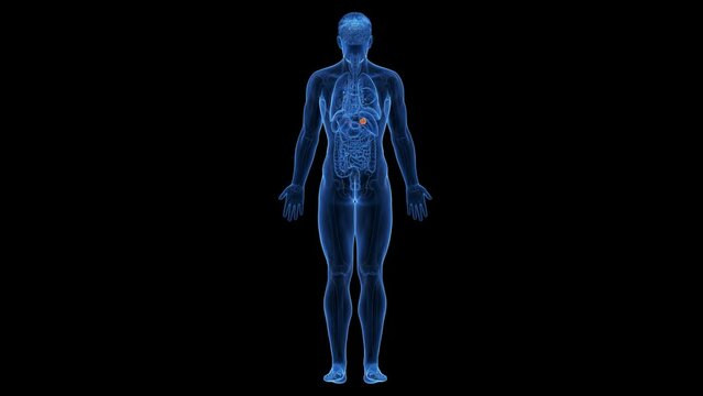 Animation of a malignant tumor in a man's adrenal gland