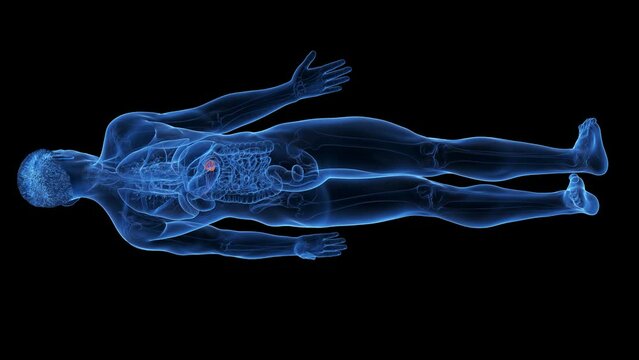 Animation of a malignant tumor in a man's pancreas