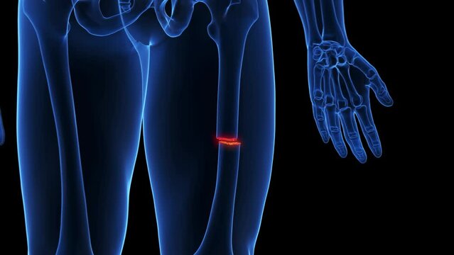Animation of a fracture of the femur