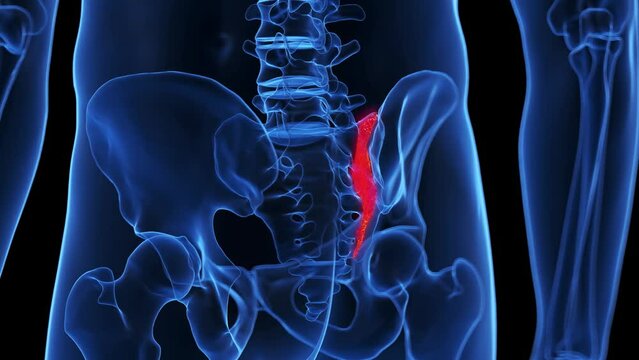 Animation of a fracture of the sacrum