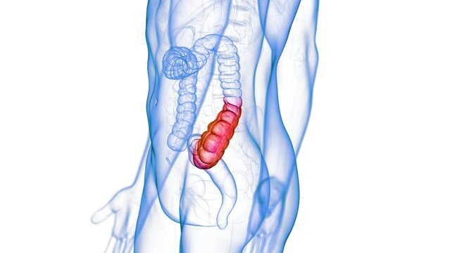 Animation of a blocked colon due to constipation