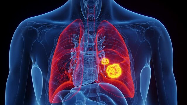 Animation of lung malignancy in a human male