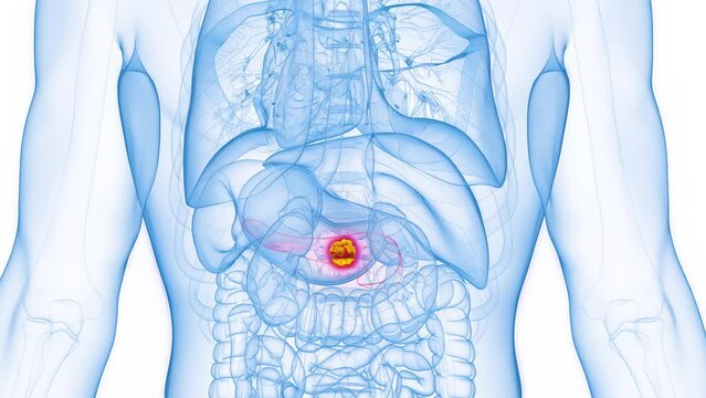 Animation of a cancerous pancreatic mass in a human male