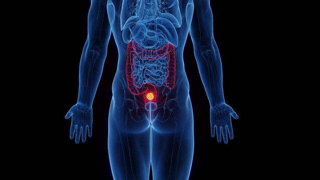 Animation of rectal carcinoma in a man