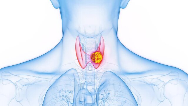 Animation of a malignant tumor in a man's right thyroid lobe