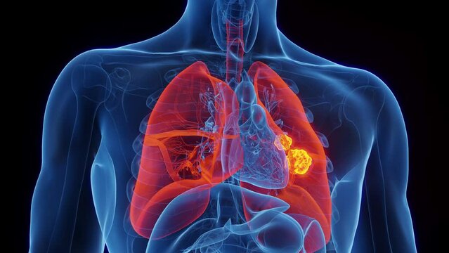 Animation of lung cancer in a human male