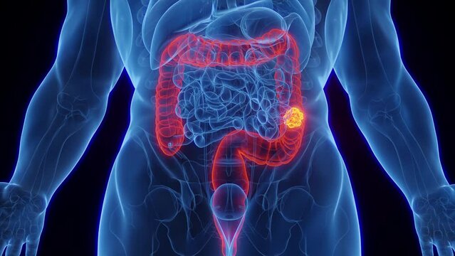 Animation of a malignant mass in a man's colon