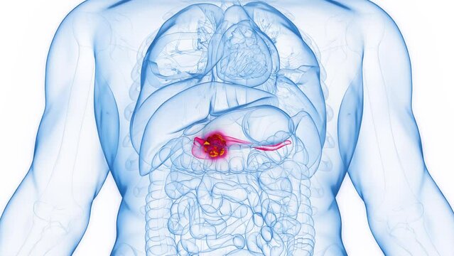 Animation of pancreatic cancer in a human male