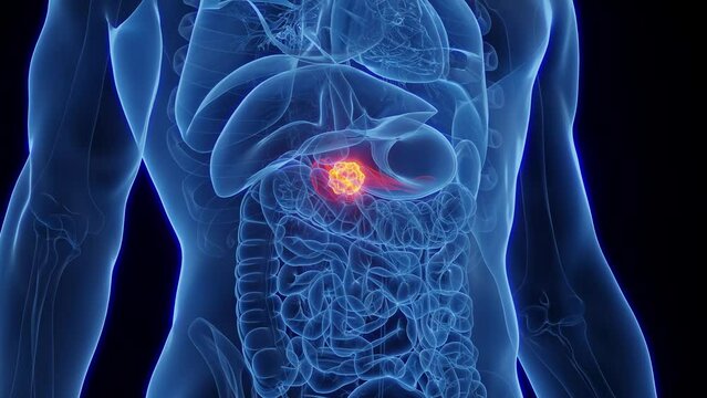 Animation of a malignant tumor in a man's pancreas