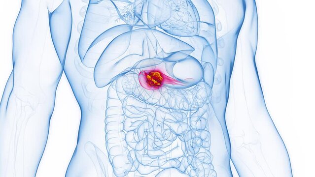 Animation of pancreatic cancer in a male human