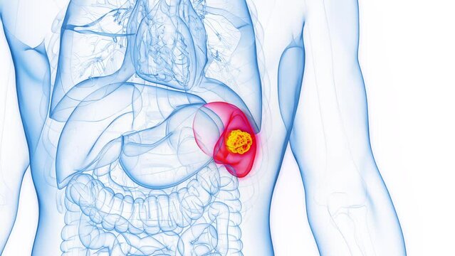 Animation of splenic cancer in an adult male