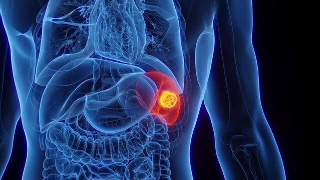 Animation of malignant splenic mass in an adult male